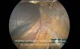 Laparoscopic Left Adrenalectomy, Step by Step