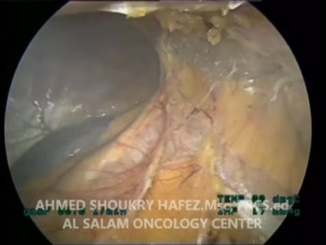 Laparoscopic Left Adrenalectomy, Step by Step