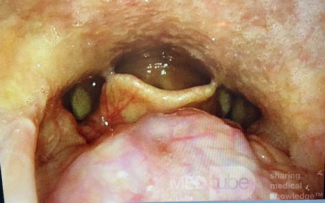 Lingual Thyroid