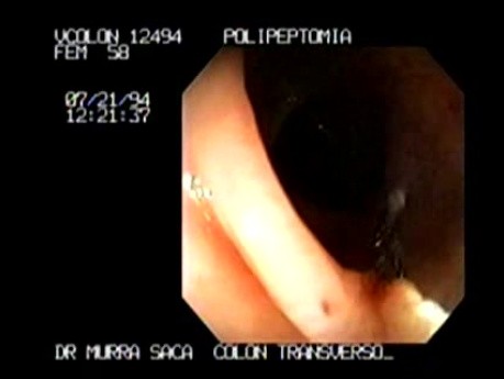 Endoscopic snare excision of large pediculated Polyp (5 of 5)