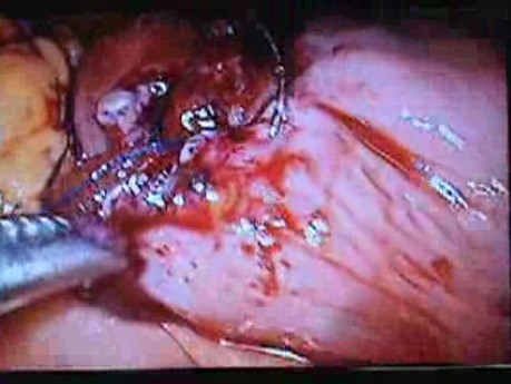 Jejunal Gastrointestinal Stromal tumor (GIST) (70 of 86)