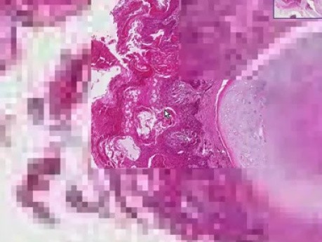 Lung - Squamous cell carcinoma