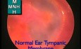 Endoscopic View Of Normal Tympanic Membrane