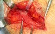 Inguinal hernia repair with mesh