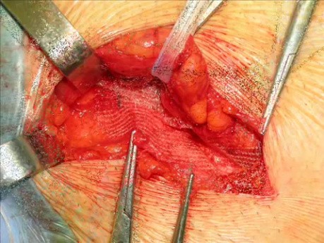 Inguinal hernia repair with mesh