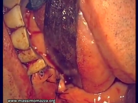 Regeneration Of Multialveolar Process (Right-Side) (3/3)