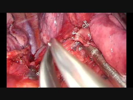 Uniportal VATS Right Posterior Segmentectomy S2