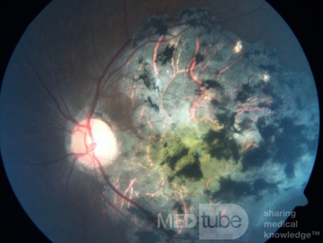 Chorio Retinal Inflammation