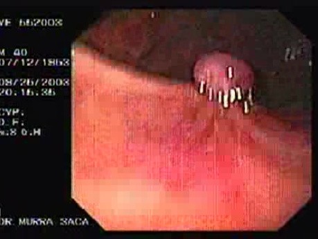 Acute Variceal Bleeding - Assessment of Gastric Cardias