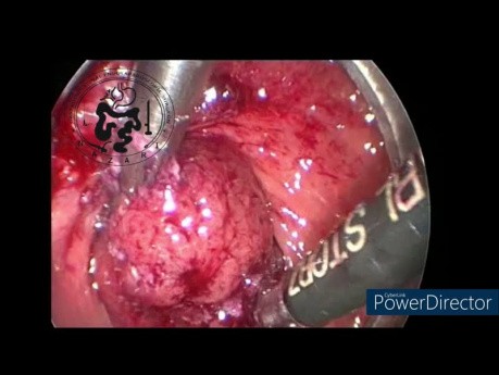 TEM Surgery