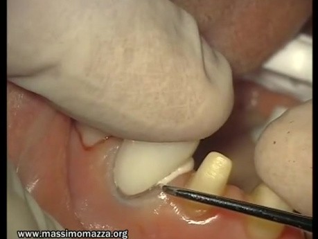 Glass Ionomer Cementation (4/6)