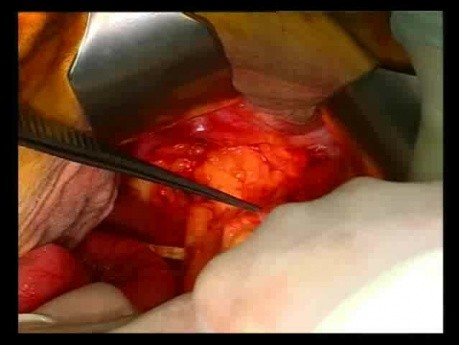 Open Right Hemicolectomy – Technical Principles - Operation No 2 - Part 1