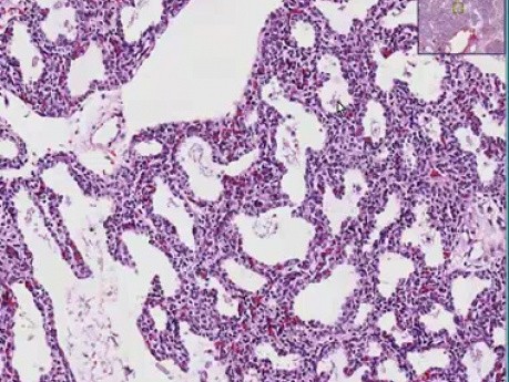Interstitial pneumonia