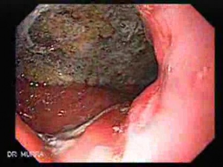 Adenocarcinoma of the Gastric Antrum That Infiltrates The Lesser Curvature (3 of 3)