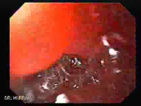 Ileal Neobladder Substitution (ileal bladder) (5 of 9)