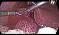 Effect of Suture Application on Bleeding From Liver Bed During Laparoscopic Cholecystectomy