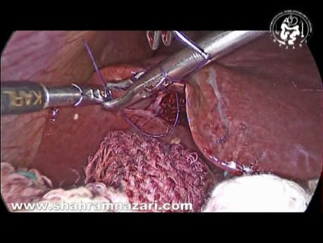 Effect of Suture Application on Bleeding From Liver Bed During Laparoscopic Cholecystectomy