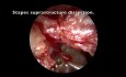 Transcanal Endoscopic PORP Tympanoplasty for Ossicular Chain Malformation