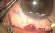 Transconjunctival filtration with bleeding
