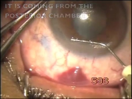 Transconjunctival filtration with bleeding