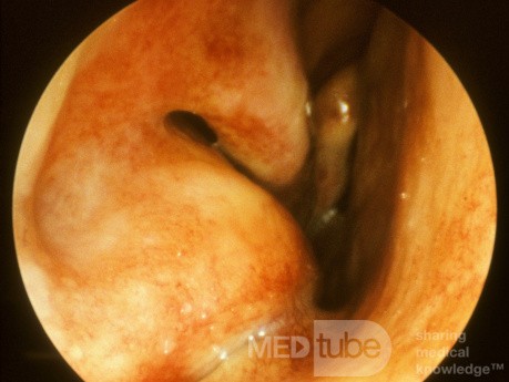 Maxillary Sinus Mucocele