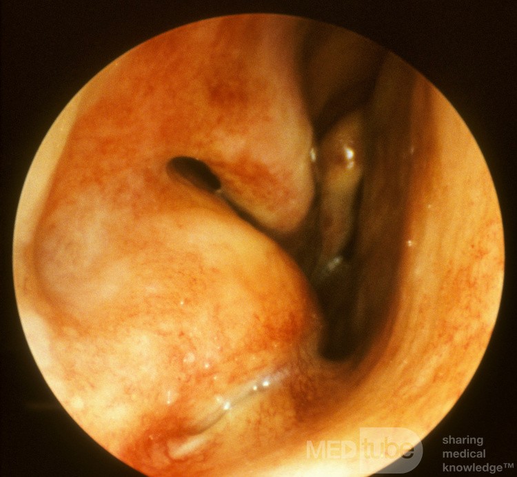 Maxillary Sinus Mucocele