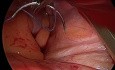 Uterine Preservation vNOTES Colpopexy