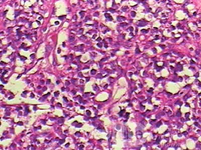 Non-Hodgkin's Lymphoma of the Colon (12 of 16)