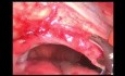 Laparoscopic Mesh Repair of Left Diaphragmatic Hernia in a Patient with Gastric Volvulus