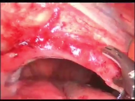 Laparoscopic Mesh Repair of Left Diaphragmatic Hernia in a Patient with Gastric Volvulus