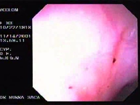 Diverticular Disease - Hemorrhage (15 of 15)