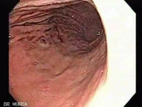 Bleeding Due to Dieulafoy´s Lesion (4 of 8)