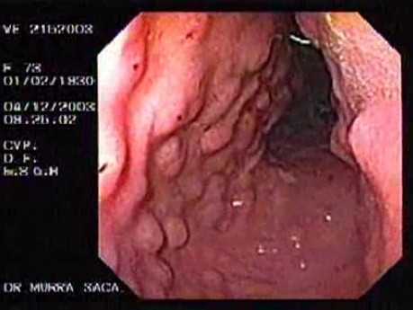 Duodenal B Cell Lymphoma (7 of 7)