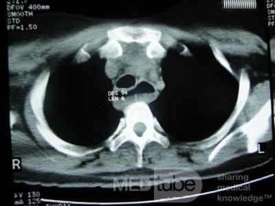 Esophagus - Pneumatic Dilation for Achalasia (28 of 31)