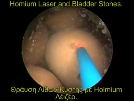 Urinary Bladder Stones