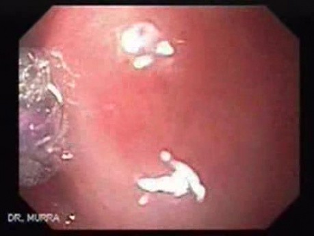 Colonic Interposition for Esophageal Substitution (4 of 11)