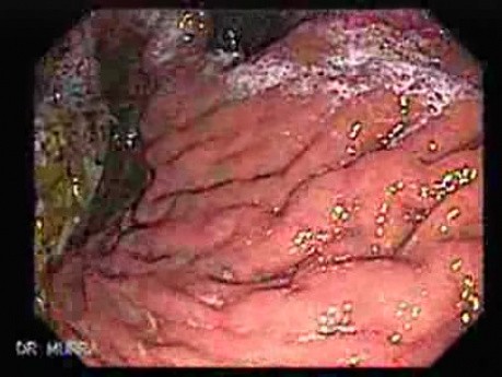 Scirrhous Gastric Carcinoma - Endoscopy (2 of 15)