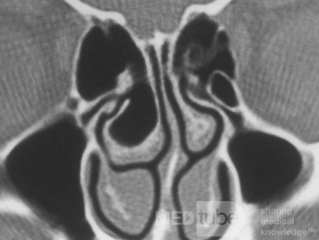 Concha Bullosa Pre-Op [CT scan]
