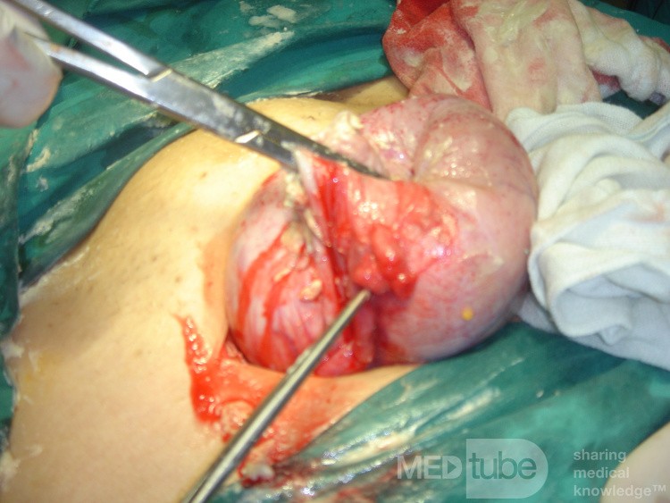 Dermoid Cyst