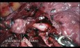 Robot Assisted Right Lower Lobectomy of the Lung