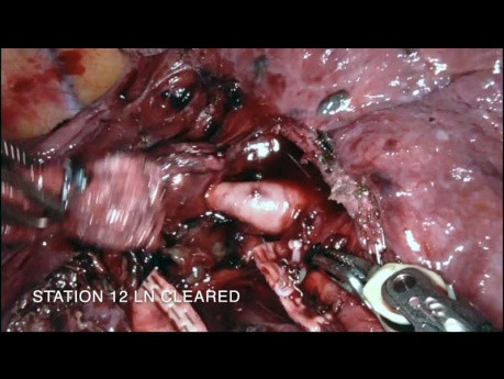 Robot Assisted Right Lower Lobectomy of the Lung