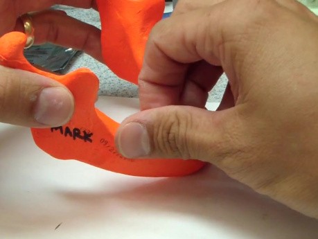 Implant Mandible