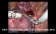 Complex Pulmonary Segmentectomy - Left S9+10 with Lobar Split