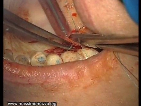 Reconstruction Of Adhesive Gingiva (2/5)