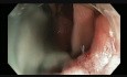Colonoscopy - Ascending Colon Giant Polyp Resection - step 2 resection