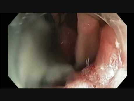 Colonoscopy - Ascending Colon Giant Polyp Resection - step 2 resection