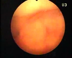 Hysteroscopic Aspect Of Adenomyosis