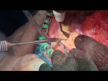Rare Location of Facial Osteoma on the Zygomatic Arch. Hemicoronal Approach.