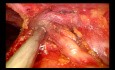 Subxiphoid Uniportal Video-assisted Thoracoscopic Total Thymectomy