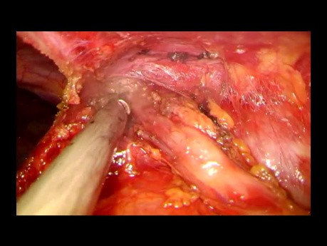 Subxiphoid Uniportal Video-assisted Thoracoscopic Total Thymectomy